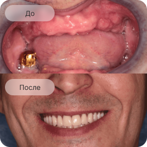Рак полости рта и ротоглотки