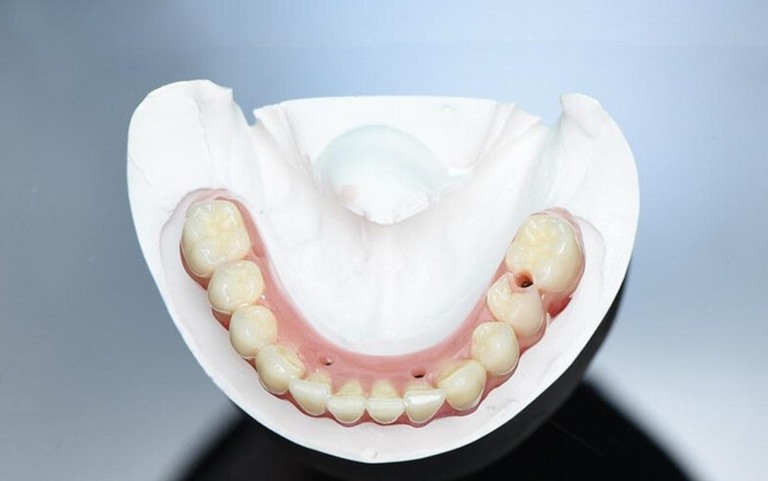Показания к установке зубных протезов
