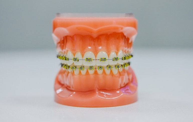 Последствия потери всех зубов
