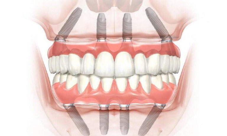 Суть зубного импланта
