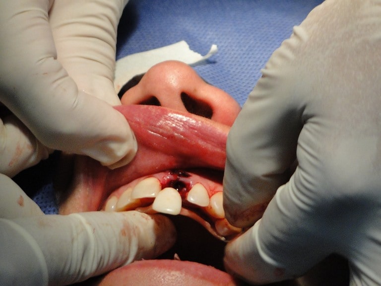 3 вида одномоментной имплантации зубов
