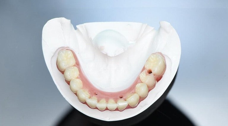 Особенности имплантации зубов и преимущества процедуры