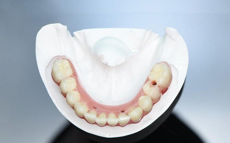 Преимущества зубных протезов