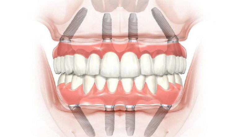 Основные виды зубных имплантов
