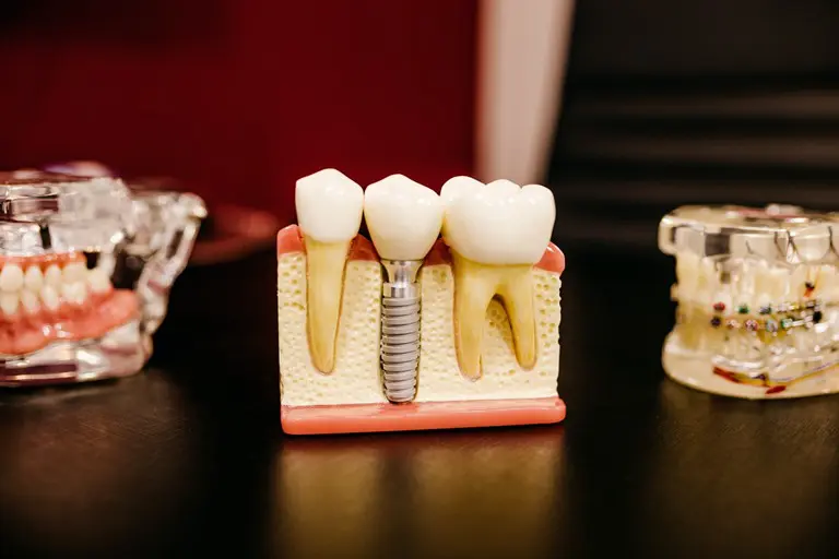 Что делать, если зубной протез натирает десну, язык или небо