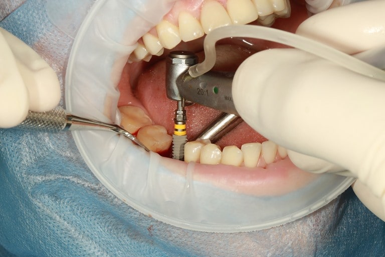 Конструктивные элементы зубного импланта
