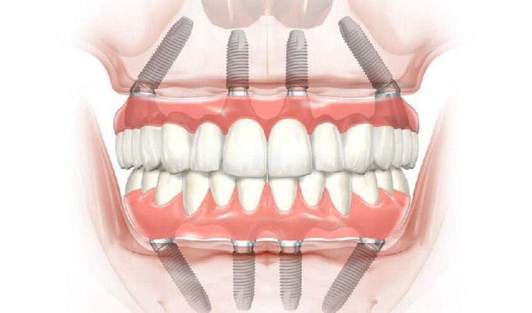 Виды несъемных зубных протезов
