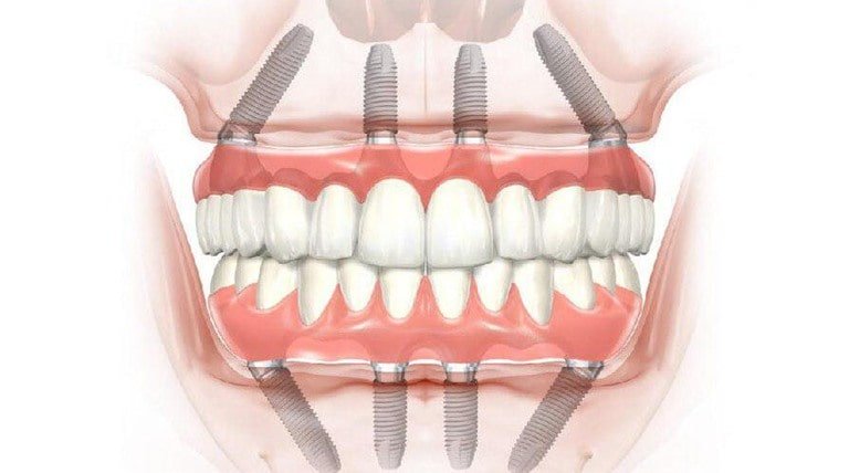 Преимущества и недостатки несъемных зубных протезов

