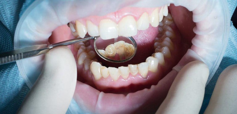 Методы удаления зубного камня
