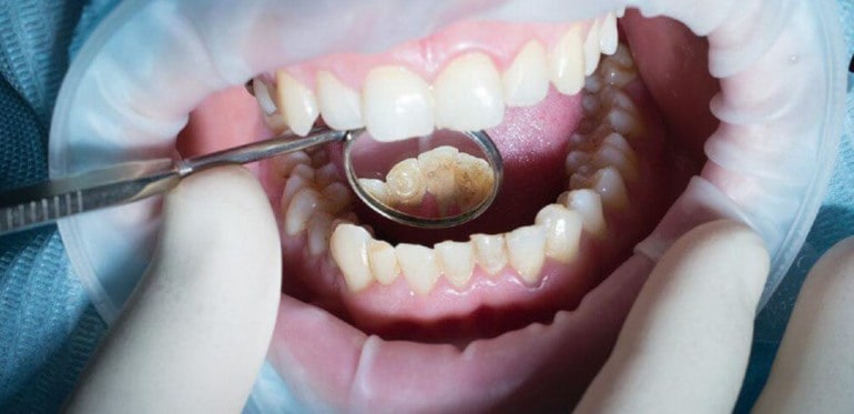 Показания и противопоказания к имплантации нижних зубов
