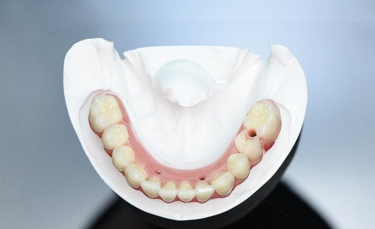 Правила ухода за несъемными зубными протезами
