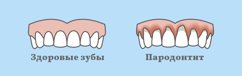 Причины пародонтита зубов