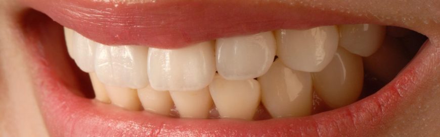 Что такое виниры для зубов: виды, материал изготовления, способы установки