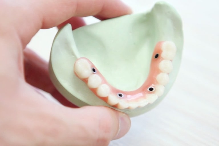 Методы установки имплантов зуба
