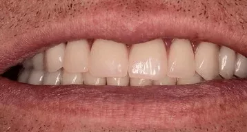 Последствия отсутствия одного или всех верхних зубов