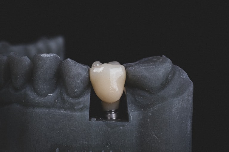 История имплантации зубов