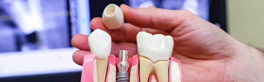Что делать, если нет зубов: протезирование при адентии