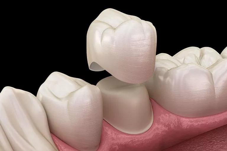 Материалы для производства зубных протезов