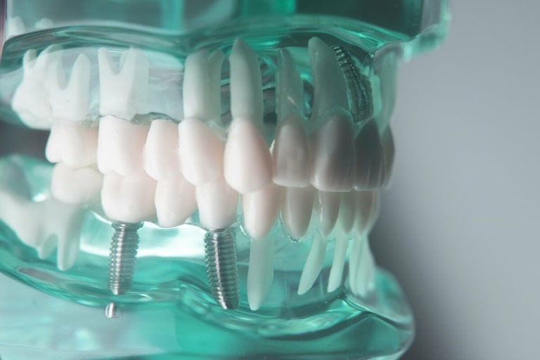 Зубные протезы на имплантах