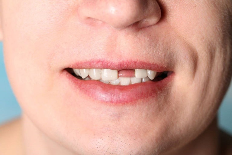 Чем грозит потеря зубов