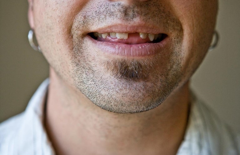 11 основных причин, почему крошатся зубы у взрослого человека