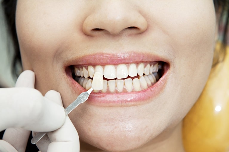 Методы реставрации зубов