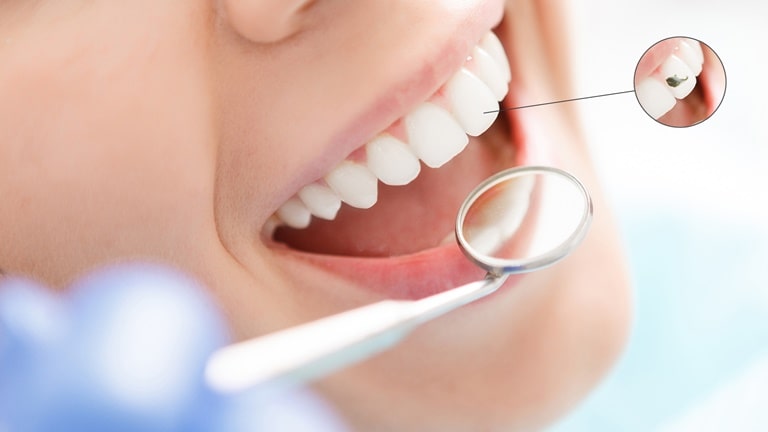 Достоинства и недостатки реставрации зубов