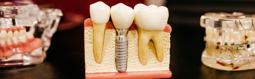 Сложное удаление зуба мудрости: особенности, этапы, восстановление