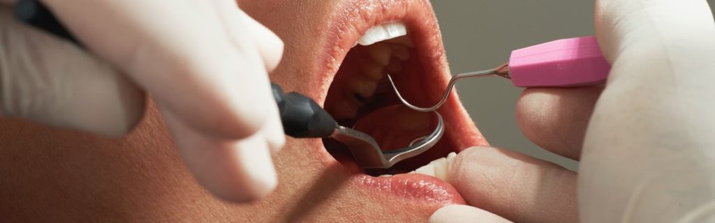 Синус-лифтинг в стоматологии: методы проведения, показания и противопоказания