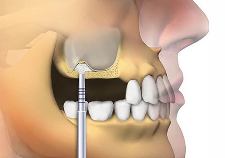 Принципы и особенности наращивания кости при имплантации