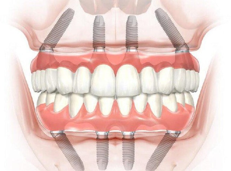 Несъемные виды протезирования зубов