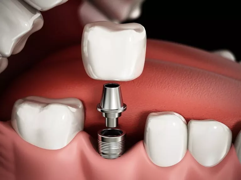 Способы и методы фиксации зубных коронок