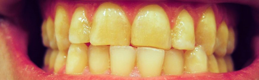 Желтый налет на зубах: причины и способы избавиться