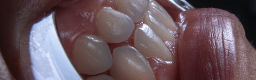 Протез на передние зубы: виды, способы установки, какой выбрать