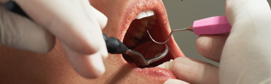 Воспаление надкостницы зуба: причины, симптомы, лечение