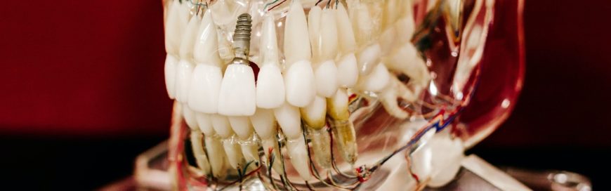 Имплант сразу после удаления зуба: показания и методика проведения