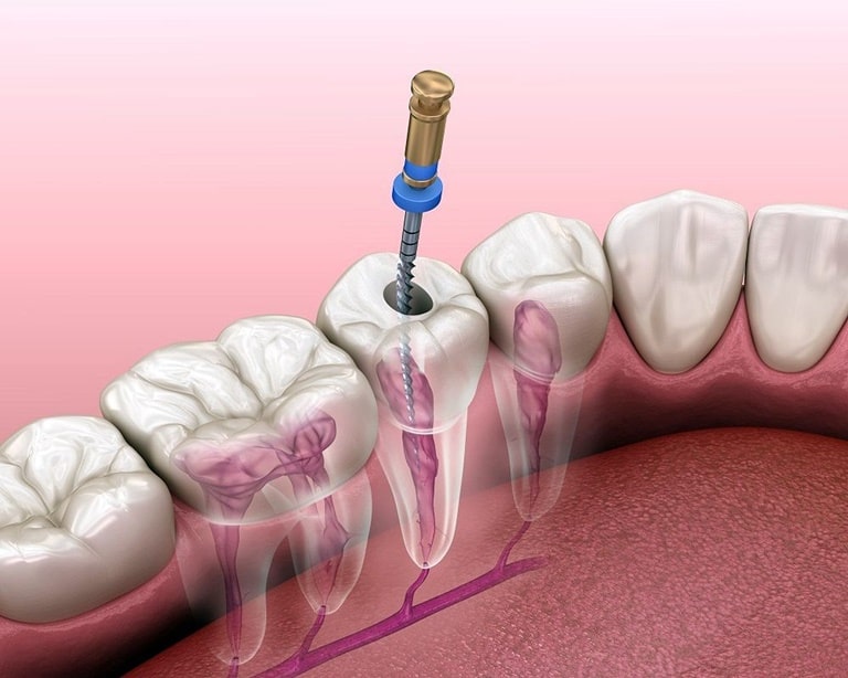 Почему болит зуб после удаления нерва и пломбирования