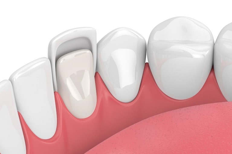 11 показаний к установке стоматологических виниров
