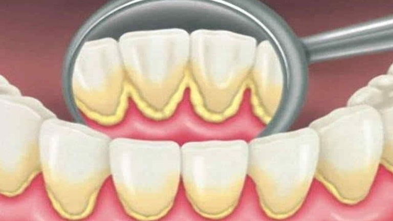 Сопутствующие желтому налету на зубах симптомы