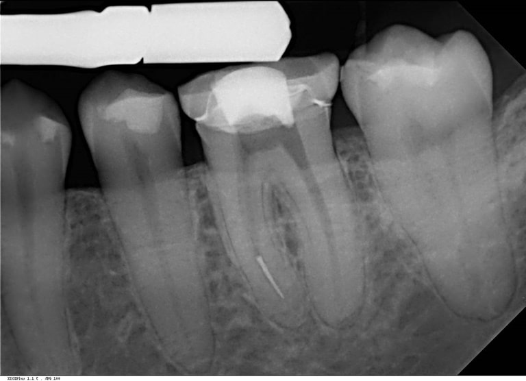 Недостаточное очищение полости зуба и корневых каналов от пораженных тканей