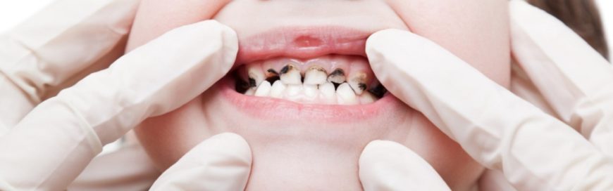 Гнилые зубы: причины, признаки, лечение