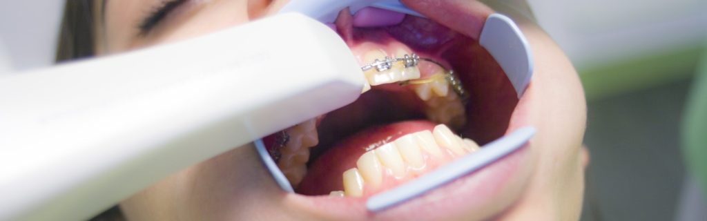 Темные пятна на зубах: причины появления и методы лечения
