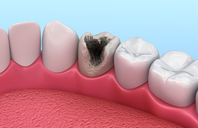 Классификация гиперестезии зубов