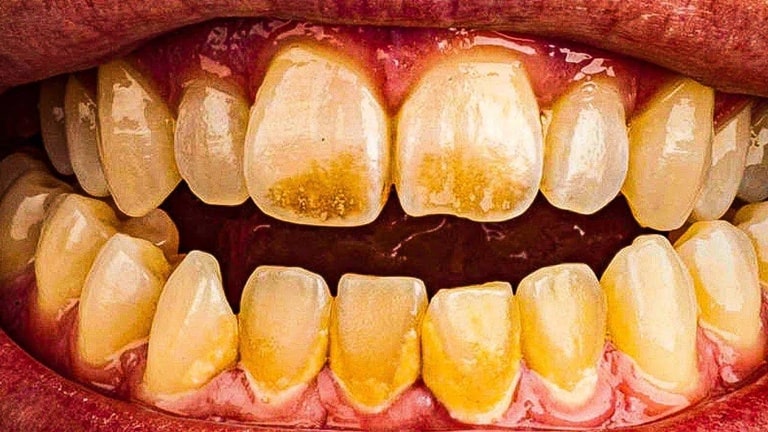2 группы причин появления темных пятен на зубах