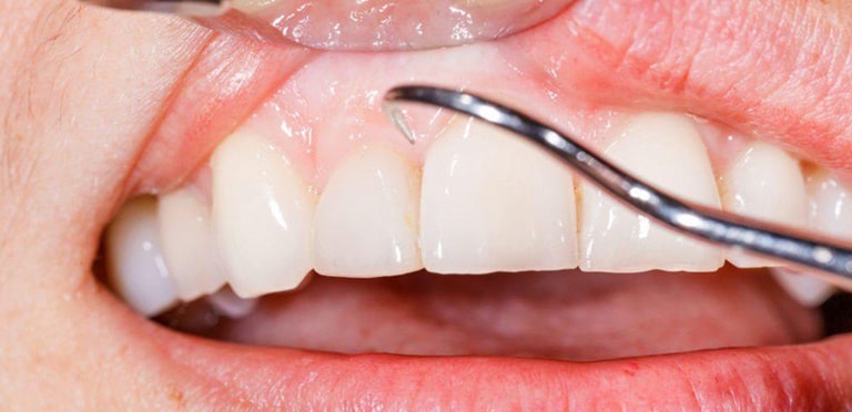 Значение кальция для здоровья зубов