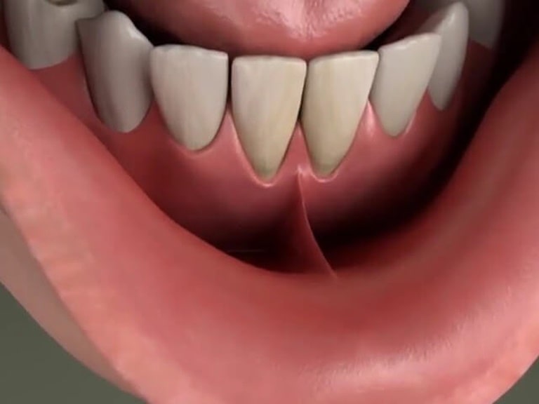 Что такое уздечка верхней губы