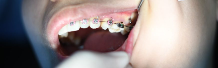 Почему зубы двигаются: причины смещения и способы коррекции