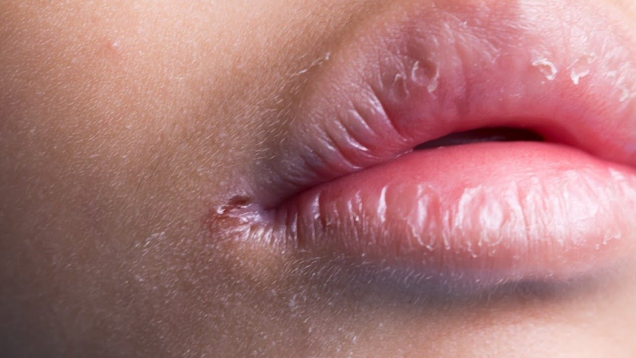 Причины появления заед в уголках рта
