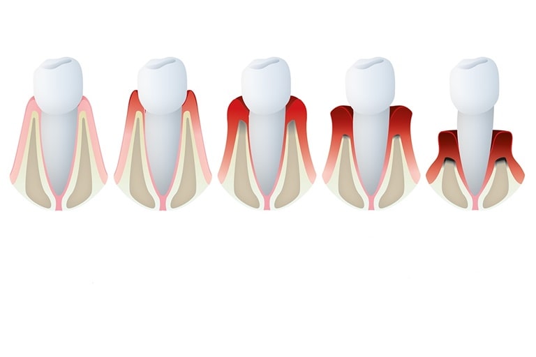 Периодонтит как ключевая причина кровоточивости зубов
