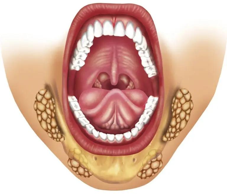 Воспаление слюнных желез под языком
